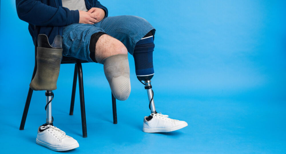 Odszkodowanie za amputację w UK