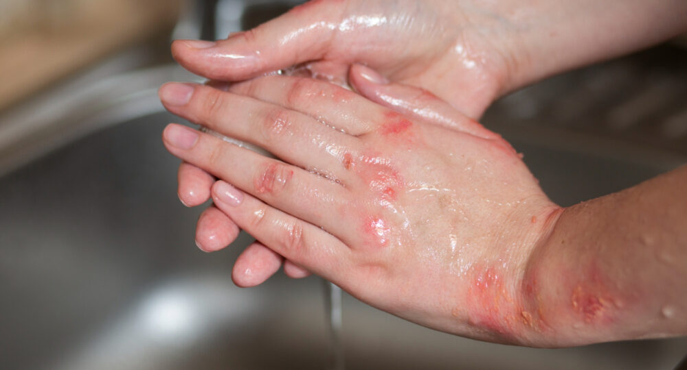 Odszkodowanie za poparzenia w UK