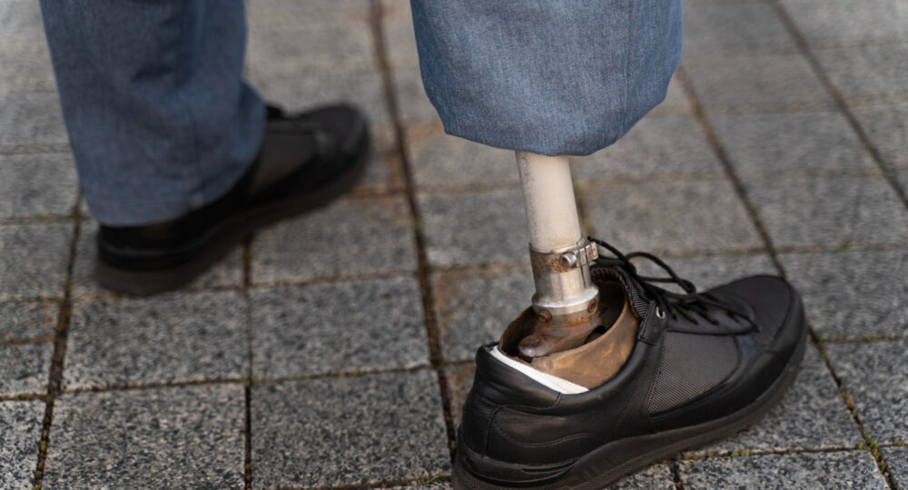 Odszkodowanie za utratę kończyny w UK najważniejsze informacje